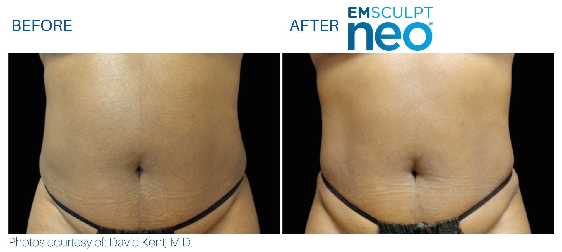 Emsculpt NEO before and after.
