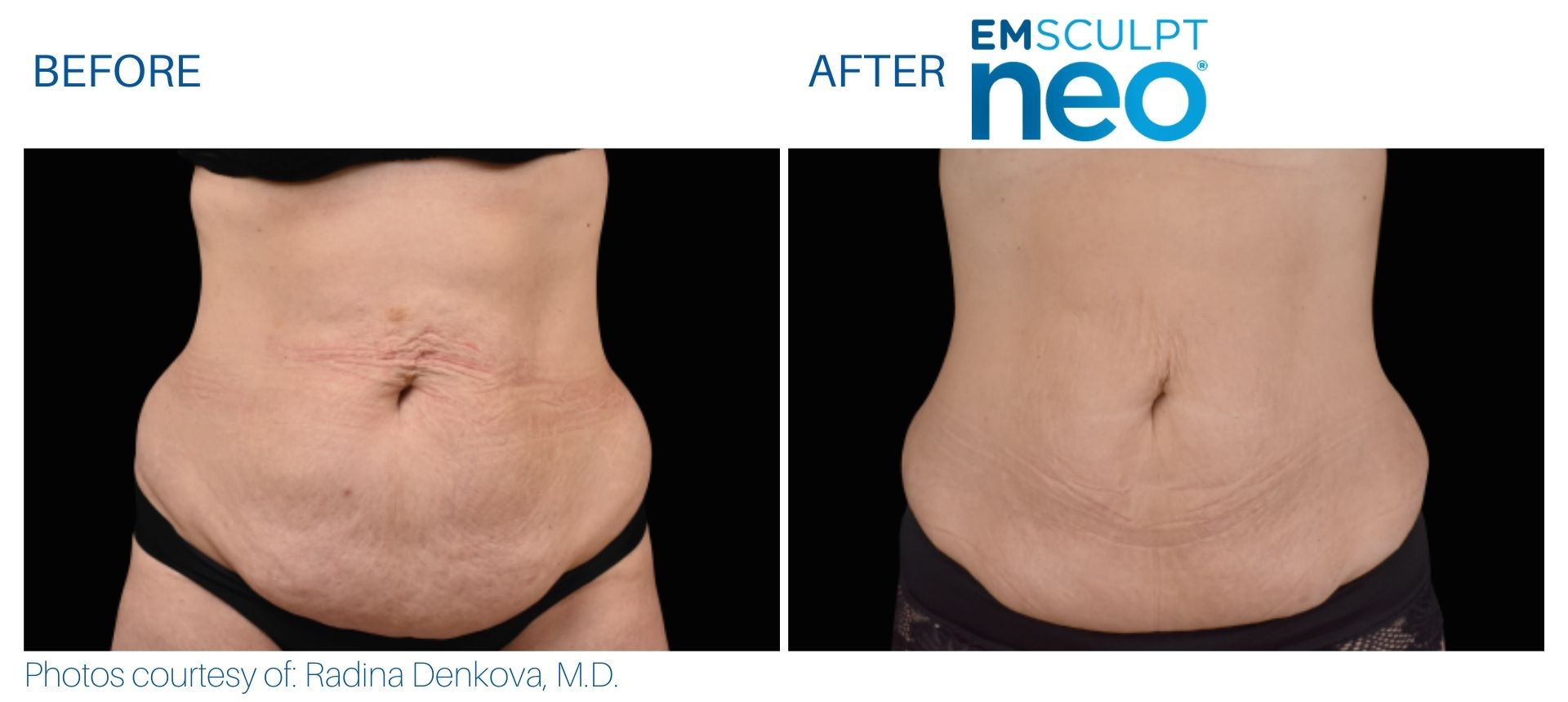 Emsculpt NEO before and after.